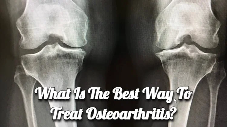 What is the Best Way to Treat Osteoarthritis?